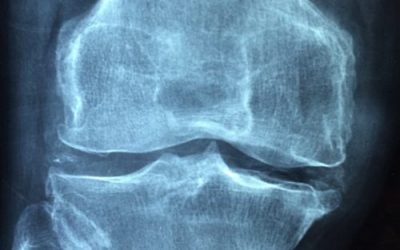 What is Prolotherapy?