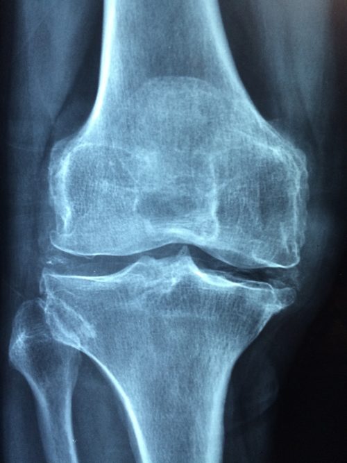 What is Prolotherapy?